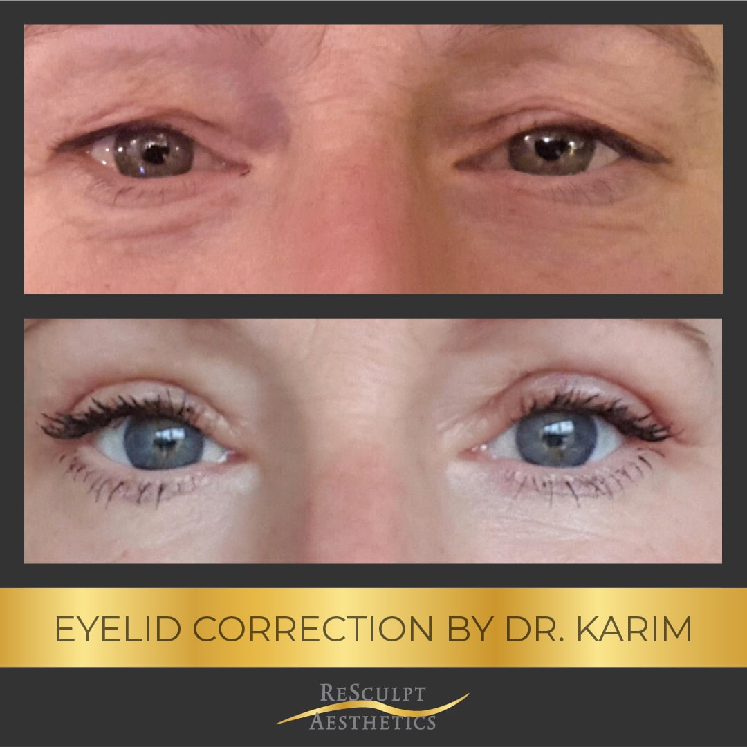 ooglid correctie, ooglidcorrectie voor en na, bovenooglidcorrectie, resculpt aesthetics, dr karim, refaat karim