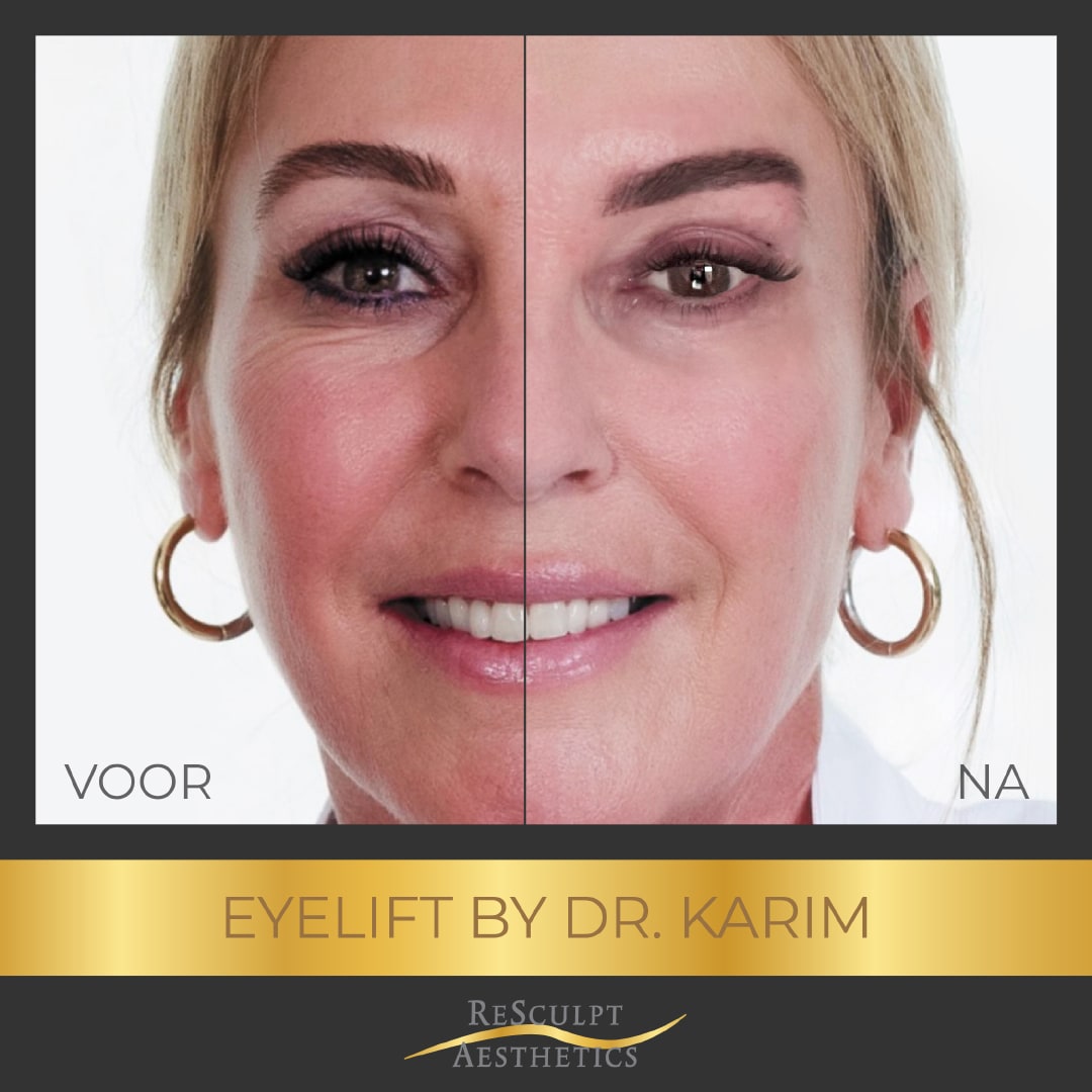 ooglid correctie, ooglidcorrectie voor en na, bovenooglidcorrectie, resculpt aesthetics, dr karim, refaat karim