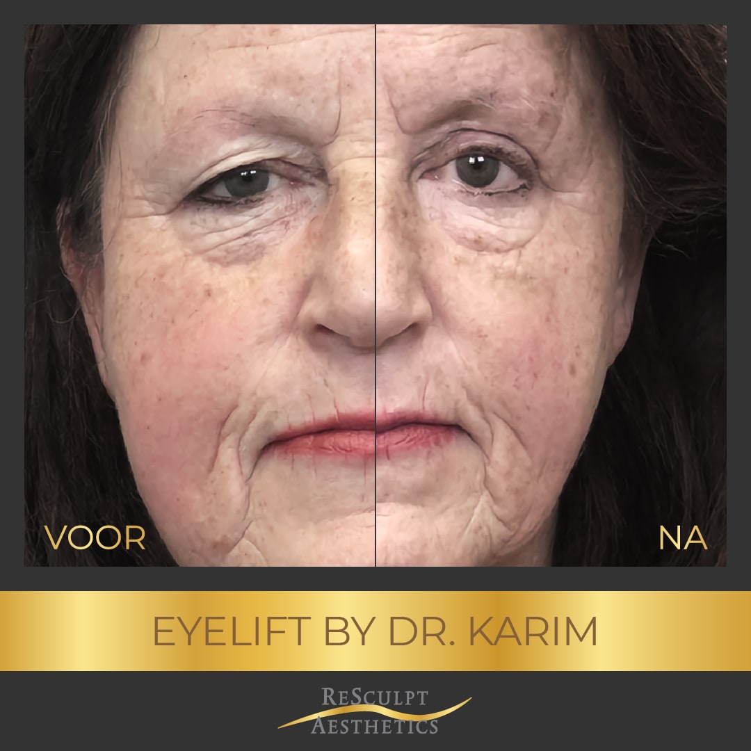 ooglidcorrectie voor en na, bovenooglidcorrectie, onderooglidcorrectie, ooglidcorrectie plastisch chirurg, aesthetics, resculpt, chirurgisch