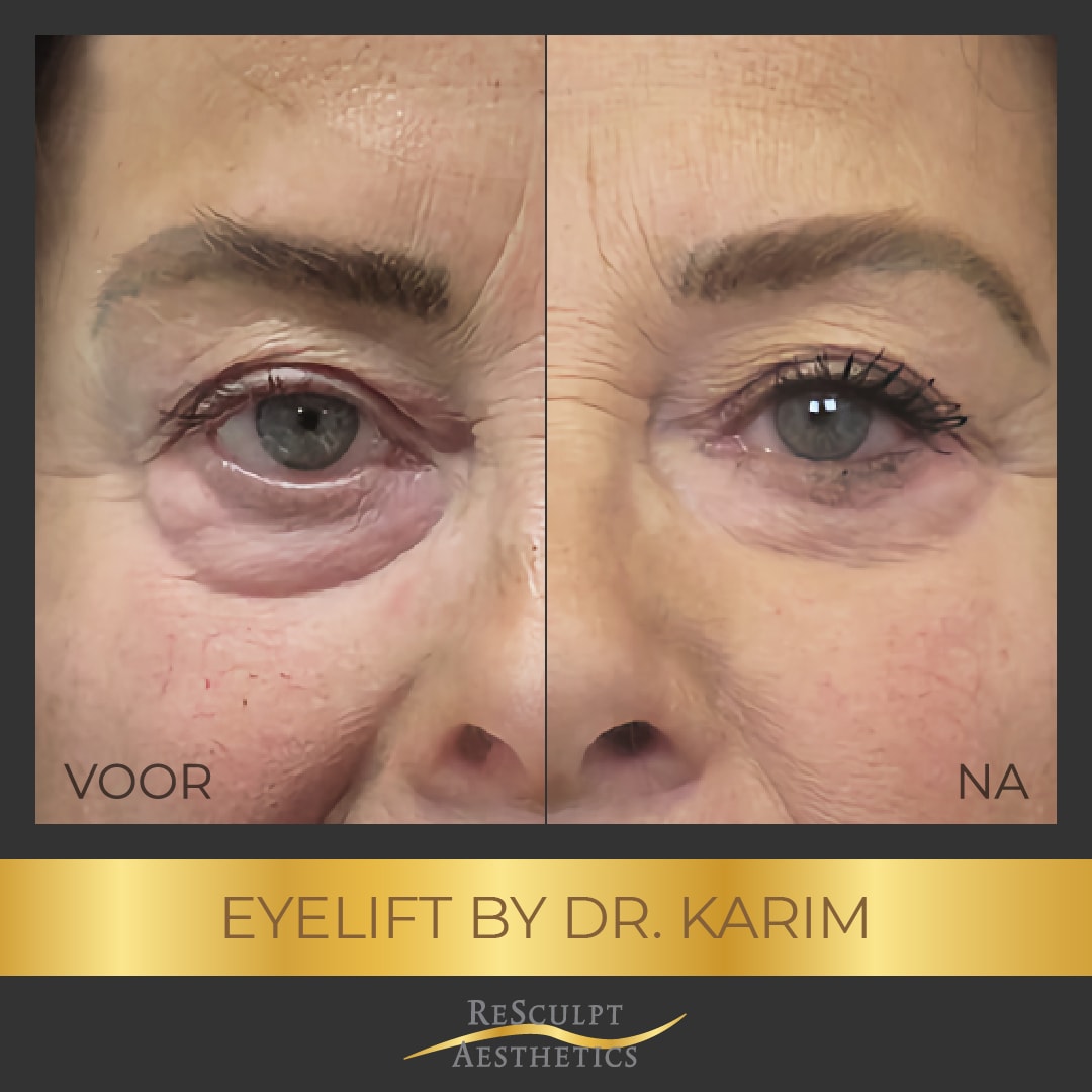 ooglidcorrectie voor en na, bovenooglidcorrectie, onderooglidcorrectie, ooglidcorrectie plastisch chirurg, aesthetics, resculpt, chirurgisch